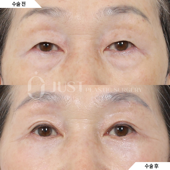 Brow Lift: Just Plastic Surgery Reveals the Secret to Great Results! image 3