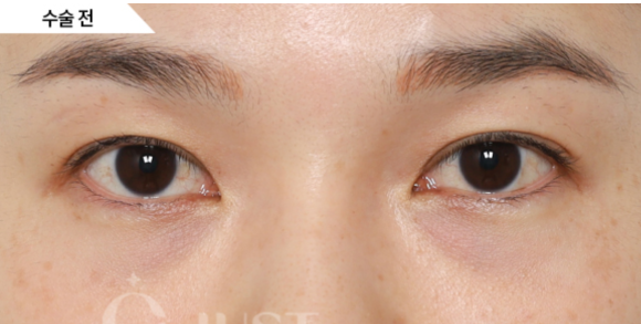 Under-Eye Fat Repositioning: 2 Self-Check Methods Explained by a Plastic Surgeon with 21 Years of Experience! image 3