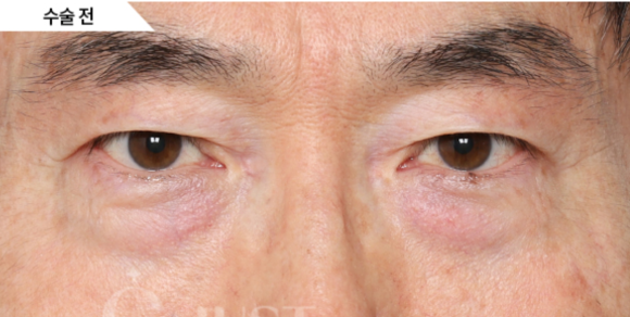 Under-Eye Fat Repositioning: 2 Self-Check Methods Explained by a Plastic Surgeon with 21 Years of Experience! image 7