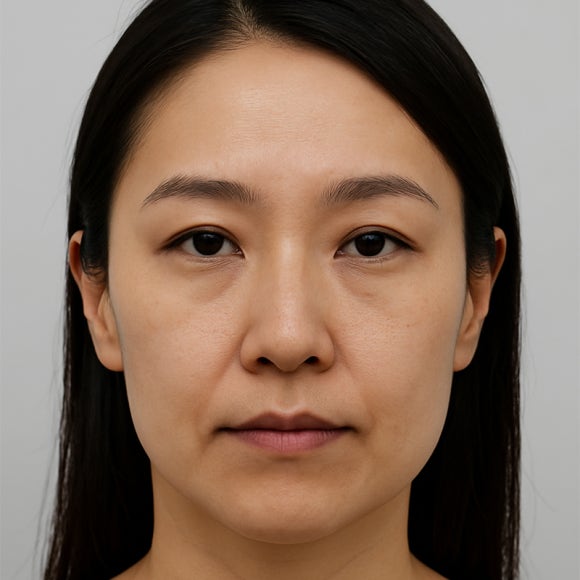 Midface Aging More Frightening Than Nasolabial Folds: How to Solve It with Lifting image 1
