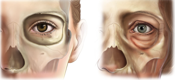 Lower Eyelid Sagging Is Caused by the 'Bone,' Not the Skin (Key Points of Lower Eyelid Fat Repositioning) image 1