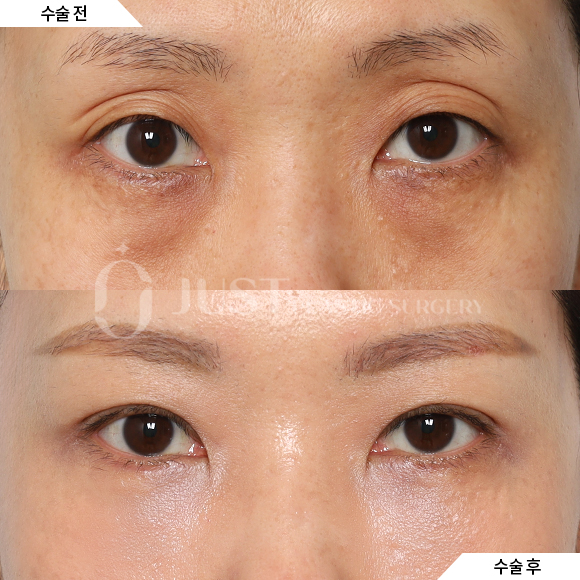 갑자기 나이들어 생긴 느끼한 쌍꺼풀, 비대칭 쌍꺼풀 어떻게 해야 하나요? 관련 이미지 4