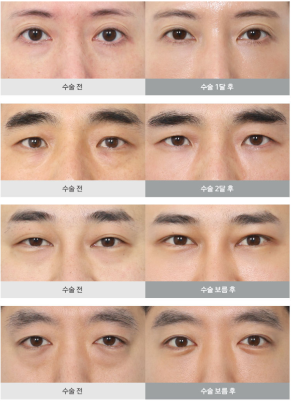 눈밑 수술, 이제는 국민 성형수술이 되다? (눈밑지방재배치와 하안검의 차이) 관련 이미지 7