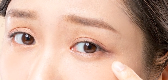 ✦ 눈밑지 상담 때 가장 많이 듣는 질문은? ✦ 2편. 마취는 안전한가요? 회복은 얼마나 걸리나요? 부작용은 없나요? 관련 이미지 4