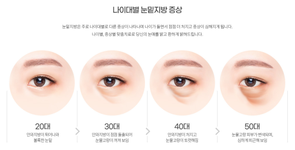 눈밑 수술, 이제는 국민 성형수술이 되다? (눈밑지방재배치와 하안검의 차이) 관련 이미지 1
