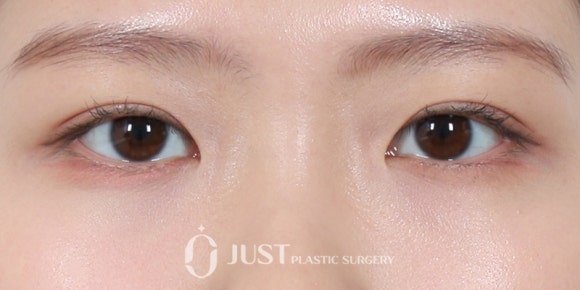 자연유착 눈매교정 안 되는 눈 5가지 - 이것만 보면 자연유착 가능한 눈의 기준 정확히 알 수 있어요! 관련 이미지 13