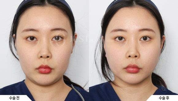 압토스 실리프팅 잘하는 곳, 임성윤 원장 압토스 트레이너로 공식 인증되었습니다! 관련 이미지 7