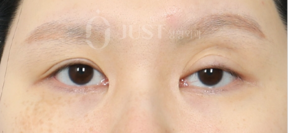 Double Eyelid Revision Surgery: The Solutions for “Sausage Eyes” and Uneven Eyes Are Different image 3