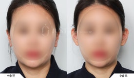 &ldquo;귀 필러 하면 얼굴 작아진다?&rdquo; 성형외과 전문의가 말하는 요정귀 필러의 효과와 매력 관련 이미지 1