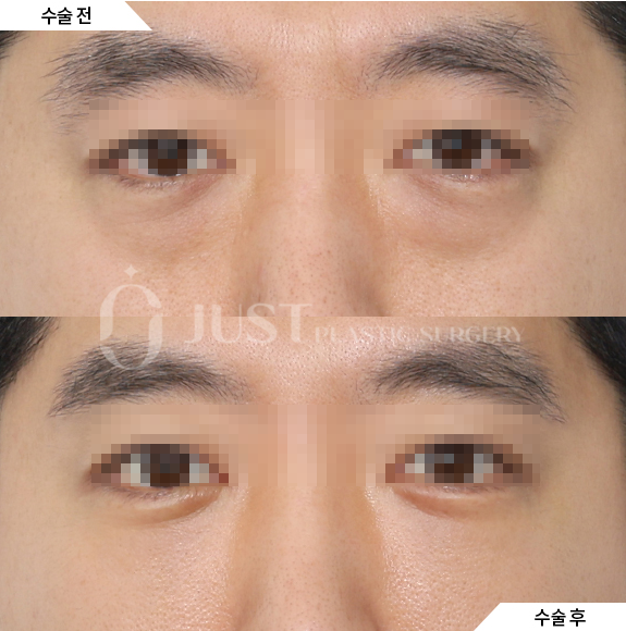 What Is the Most Common Question During a Lower Eyelid Fat Repositioning Consultation? Part 1. What Improvements Does It Make? image 3