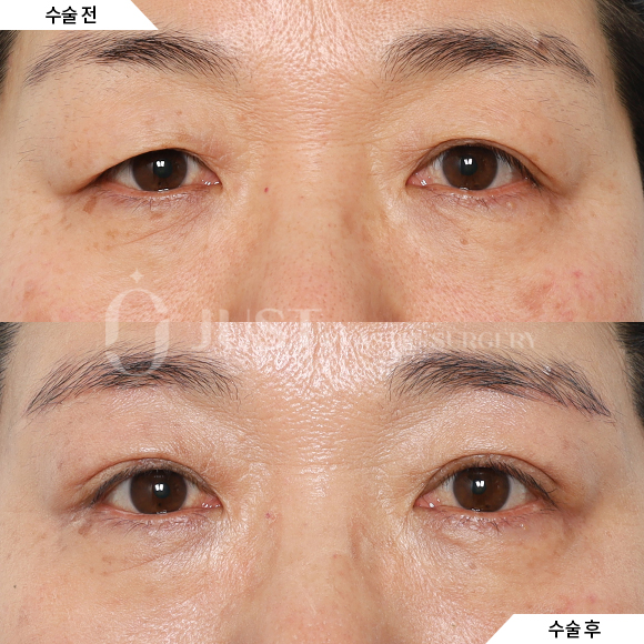 Brow Lift: Just Plastic Surgery Reveals the Secret to Great Results! image 8