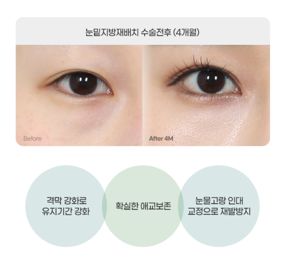 What Is the Most Common Question During a Lower Eyelid Fat Repositioning Consultation? Part 1. What Improvements Does It Make? image 6