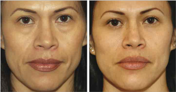 Lower Eyelid Sagging Is Caused by the 'Bone,' Not the Skin (Key Points of Lower Eyelid Fat Repositioning) image 3