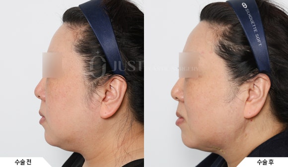 Just Plastic Surgery Clinic Aptos vs. Other Thread Lifting: 2 Selection Criteria Revealed image 6