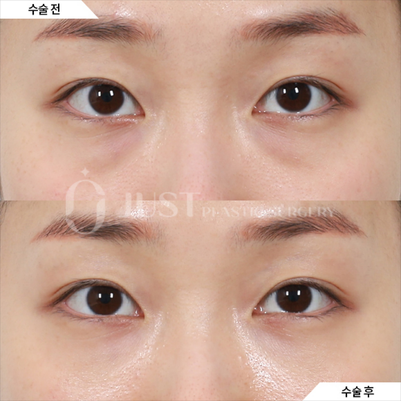 Drawbacks of Lower Eyelid Fat Repositioning—and Why Combining It with Peach Lifting Can Help! image 2
