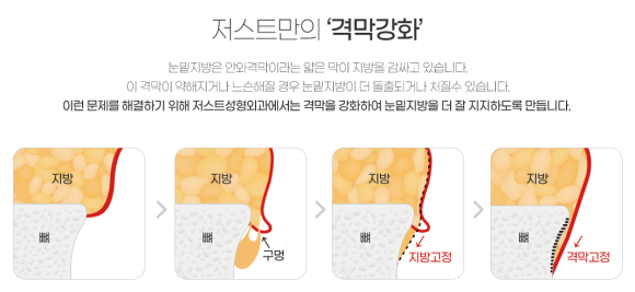 눈밑 수술, 이제는 국민 성형수술이 되다? (눈밑지방재배치와 하안검의 차이) 관련 이미지 4
