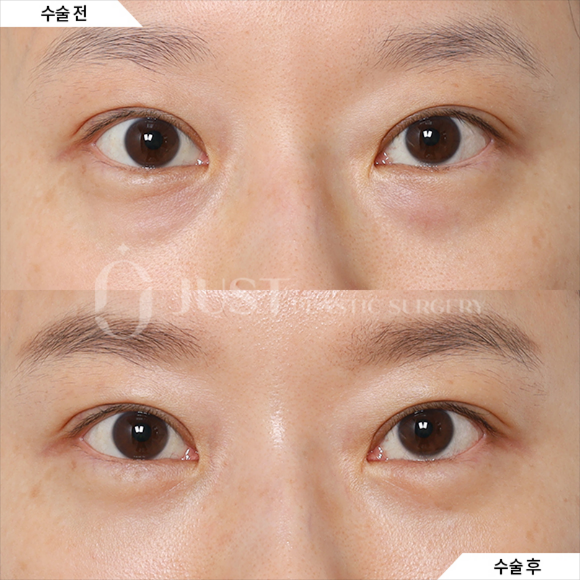 Drawbacks of Lower Eyelid Fat Repositioning—and Why Combining It with Peach Lifting Can Help! image 3