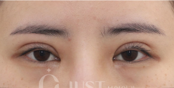Double Eyelid Revision Surgery: The Solutions for “Sausage Eyes” and Uneven Eyes Are Different image 1