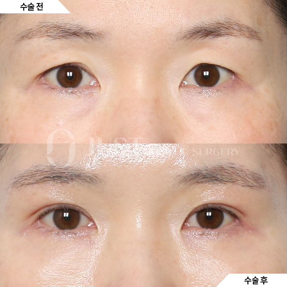 Brow Lift: Just Plastic Surgery Reveals the Secret to Great Results! image 6