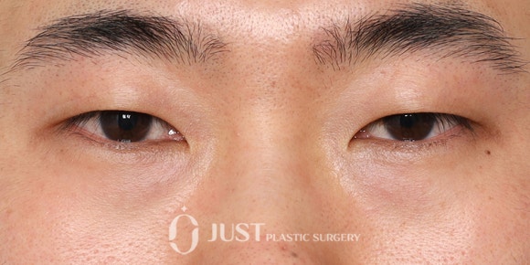 자연유착 눈매교정 안 되는 눈 5가지 - 이것만 보면 자연유착 가능한 눈의 기준 정확히 알 수 있어요! 관련 이미지 7