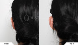 &ldquo;귀 필러 하면 얼굴 작아진다?&rdquo; 성형외과 전문의가 말하는 요정귀 필러의 효과와 매력 관련 이미지 8