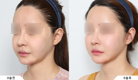 Midface Lifting: Start with Peach Silhouette Lifting at Just. image 5