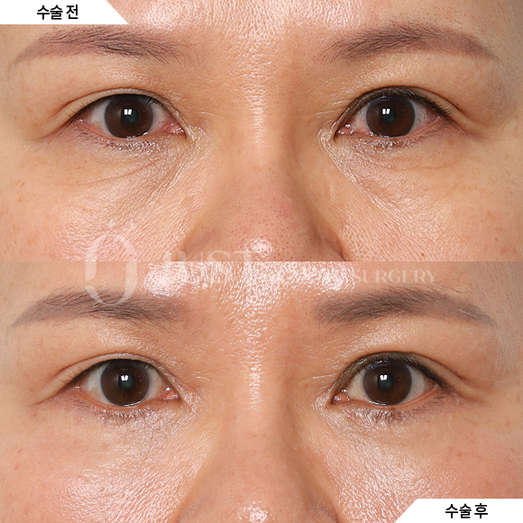 How to Address Under-Eye Wrinkles—Find Out When Lower Blepharoplasty Is Really Needed! image 2