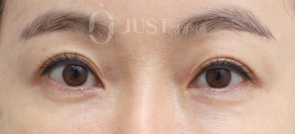Sunken Upper Eyelids: When Should You Get Fat Grafting? image 2
