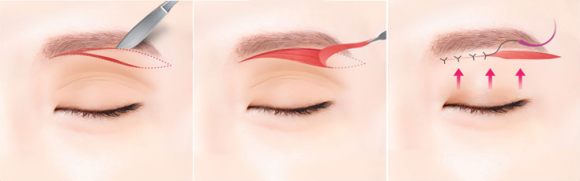 Brow Lift: Just Plastic Surgery Reveals the Secret to Great Results! image 2