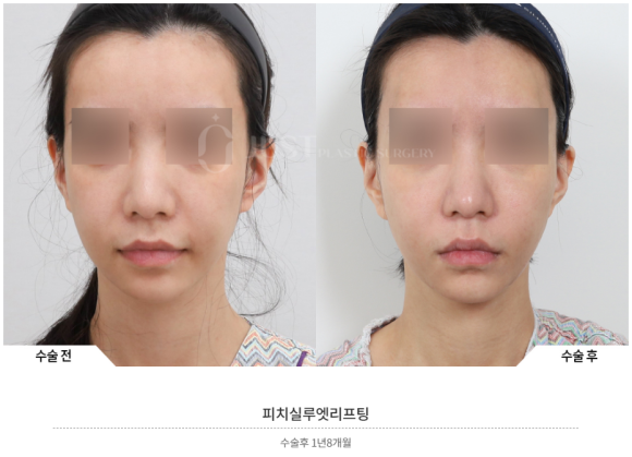 실리프팅, 안면거상 하던 성형외과 전문의가 왜 시작하게 되었는지? 관련 이미지 10