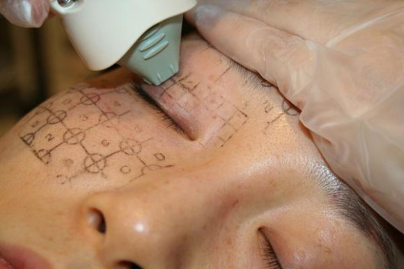 Thermage Is Good for Fine Wrinkles — Why Thermage FLX Is So Popular at Just Plastic Surgery! image 7