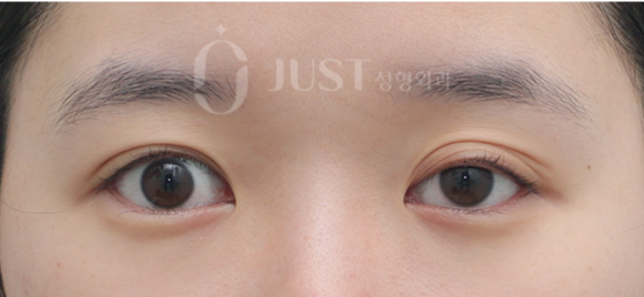 Double Eyelid Revision Surgery: The Solutions for “Sausage Eyes” and Uneven Eyes Are Different image 4