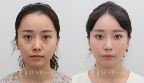 Drawbacks of Lower Eyelid Fat Repositioning—and Why Combining It with Peach Lifting Can Help! image 8