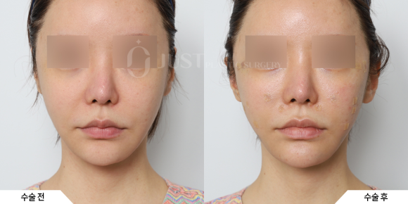 What Is Ozempic Face? Just Plastic Surgery Presents Solutions! image 3