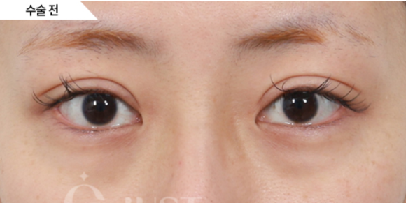Under-Eye Fat Repositioning: 2 Self-Check Methods Explained by a Plastic Surgeon with 21 Years of Experience! image 6