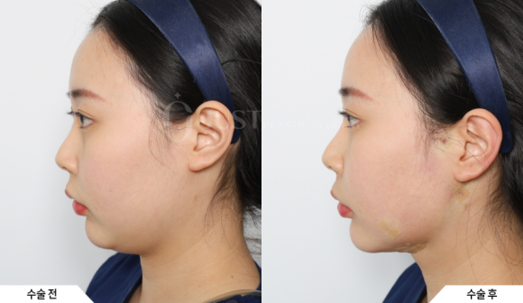Just Plastic Surgery Clinic Aptos vs. Other Thread Lifting: 2 Selection Criteria Revealed image 5