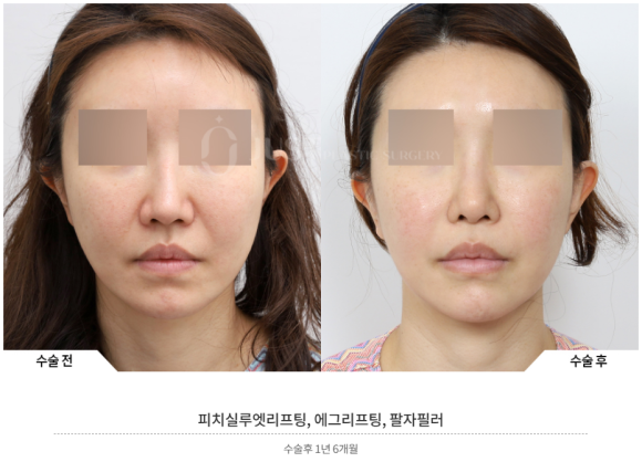 실리프팅, 안면거상 하던 성형외과 전문의가 왜 시작하게 되었는지? 관련 이미지 9