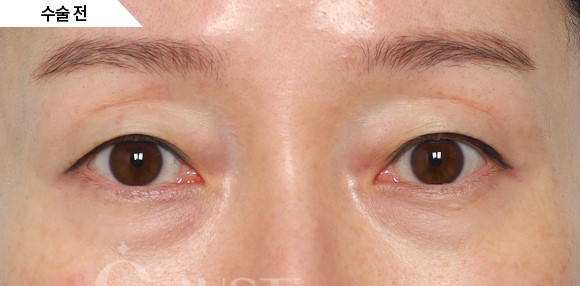 내가&hellip; 꺼진 눈이라고요?! (꺼진 눈은 어떤 눈인지, 알려드립니다) 관련 이미지 2