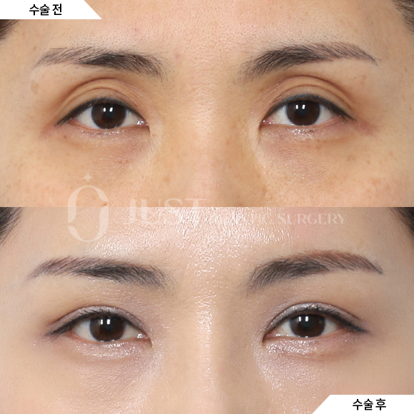 Sunken Upper Eyelids: When Should You Get Fat Grafting? image 3