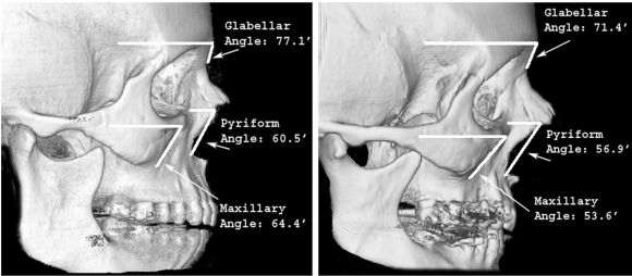Lower Eyelid Sagging Is Caused by the 'Bone,' Not the Skin (Key Points of Lower Eyelid Fat Repositioning) image 2