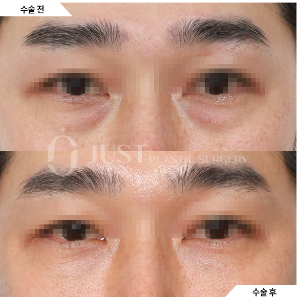 What Is the Most Common Question During a Lower Eyelid Fat Repositioning Consultation? Part 1. What Improvements Does It Make? image 1