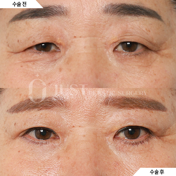 Brow Lift: Just Plastic Surgery Reveals the Secret to Great Results! image 7