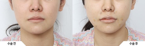 인기 레이저 TOP2 써마지 vs 울쎄라, 도대체 무슨 차이가 있는 걸까요? 관련 이미지 3