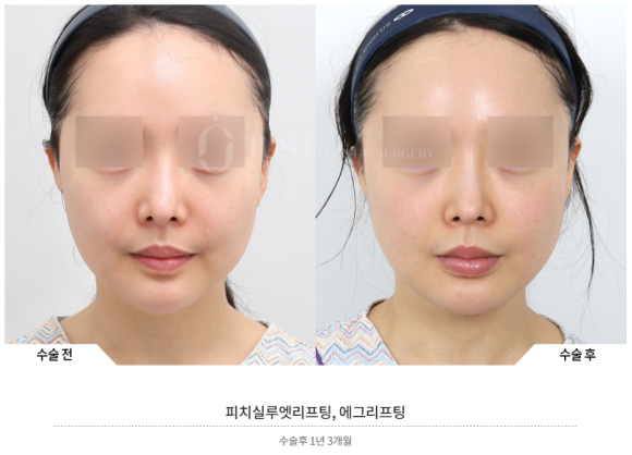 실리프팅, 안면거상 하던 성형외과 전문의가 왜 시작하게 되었는지? 관련 이미지 8