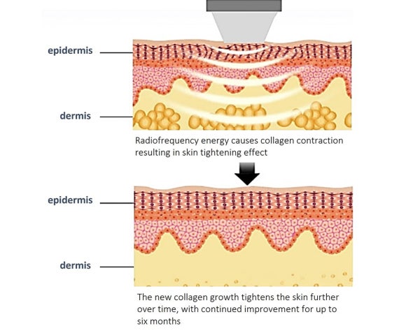Thermage Is Good for Fine Wrinkles — Why Thermage FLX Is So Popular at Just Plastic Surgery! image 4