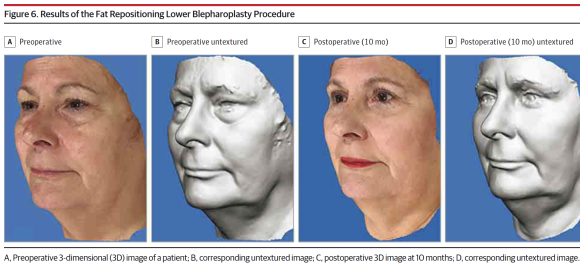 Lower Eyelid Sagging Is Caused by the 'Bone,' Not the Skin (Key Points of Lower Eyelid Fat Repositioning) image 4