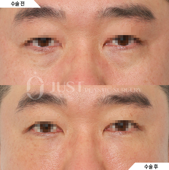 ✦ 눈밑지 상담 때 가장 많이 듣는 질문은? ✦                             3편. 지방이식 꼭 해야 하나요? 함께 하면 좋은 시술은 무엇이 있나요? 관련 이미지 1