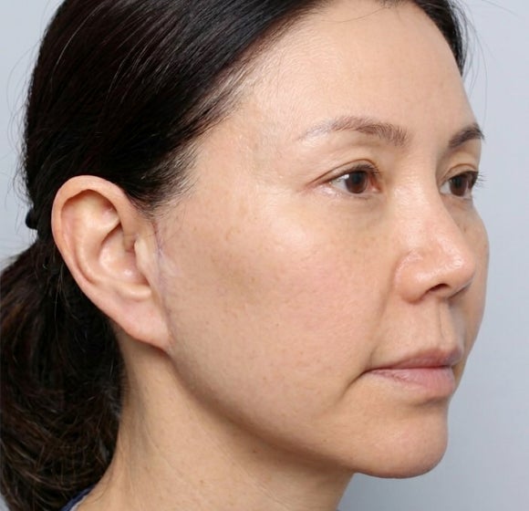실리프팅, 안면거상 하던 성형외과 전문의가 왜 시작하게 되었는지? 관련 이미지 3