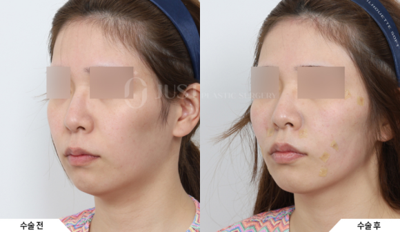 Midface Lifting: Start with Peach Silhouette Lifting at Just. image 7