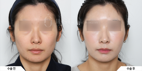 What Is Ozempic Face? Just Plastic Surgery Presents Solutions! image 5